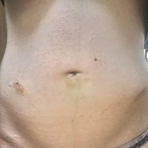 Ovarian Laparoscopy Scars